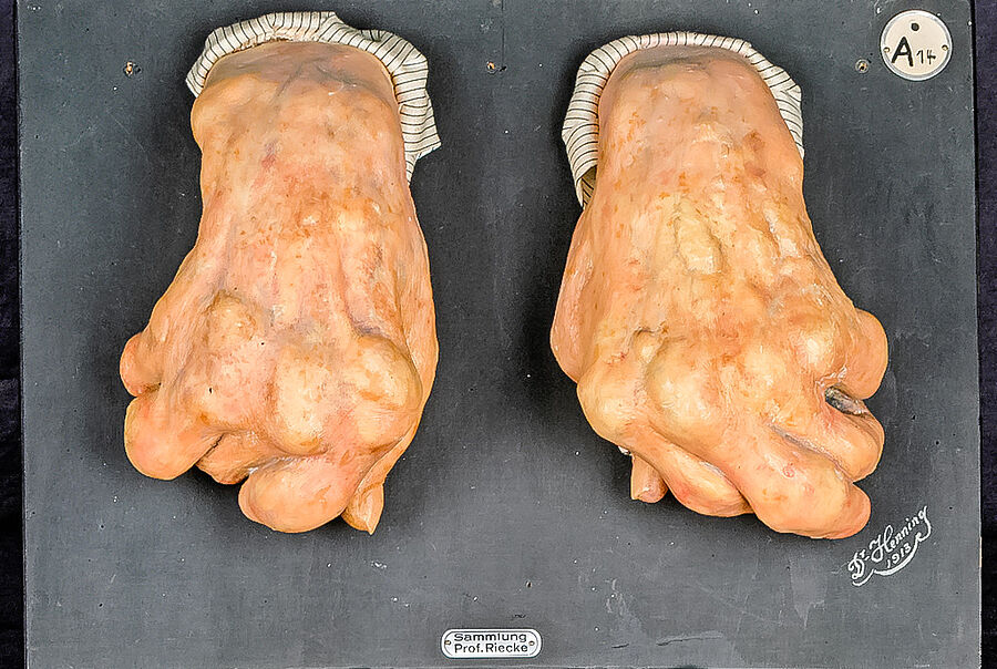 Moulage „Arthritis urica gravis manuum“ (Arthritis) Hände in der Medizingeschichtlichen Sammlung Göttingen