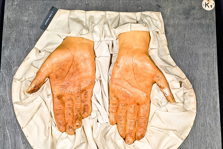 Moulage „Keratoma hereditarum palmare“ (Verhornungsstörung der Haut), Hände in der Medizingeschichtlichen Sammlung Göttingen